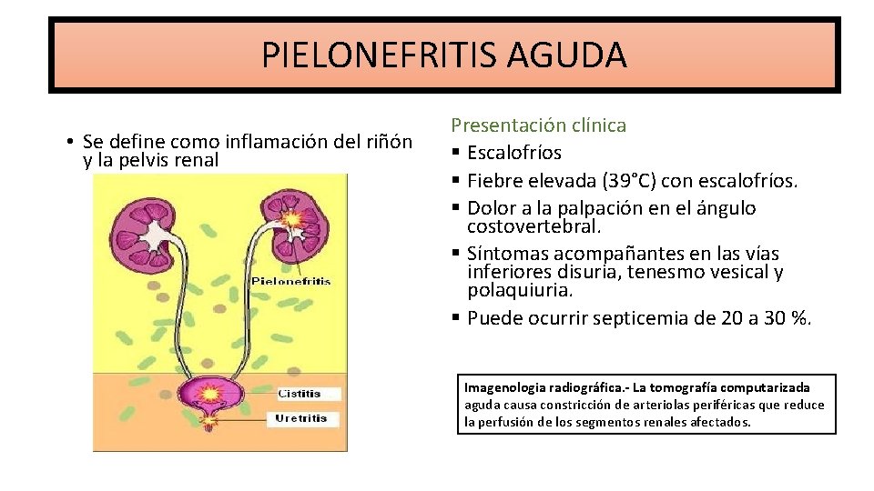 PIELONEFRITIS AGUDA • Se define como inflamación del riñón y la pelvis renal Presentación