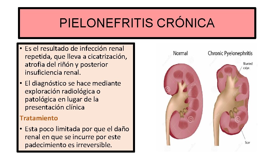 PIELONEFRITIS CRÓNICA • Es el resultado de infección renal repetida, que lleva a cicatrización,