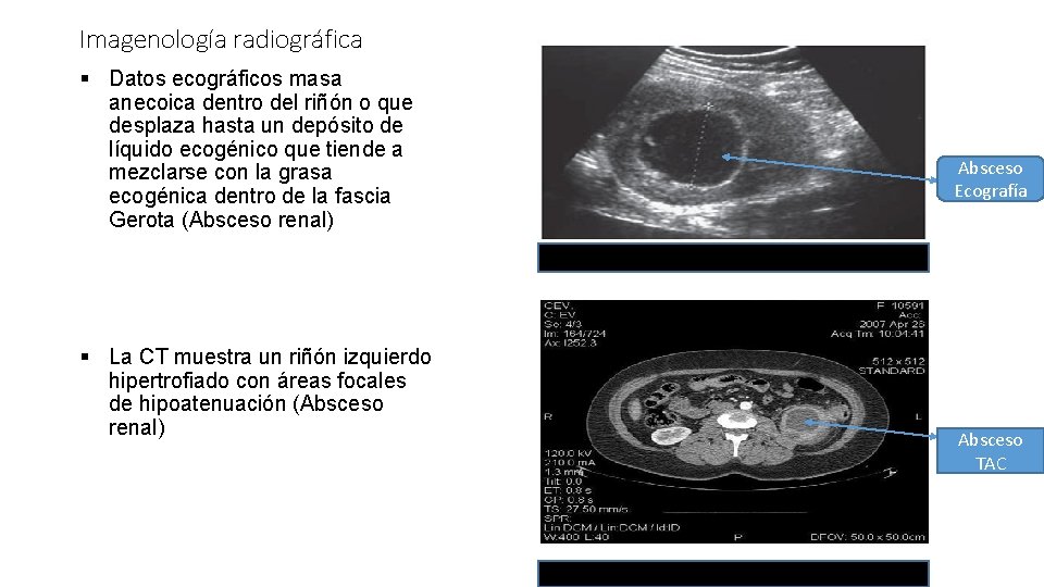 Imagenología radiográfica § Datos ecográficos masa anecoica dentro del riñón o que desplaza hasta