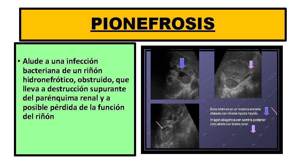 PIONEFROSIS • Alude a una infección bacteriana de un riñón hidronefrótico, obstruido, que lleva