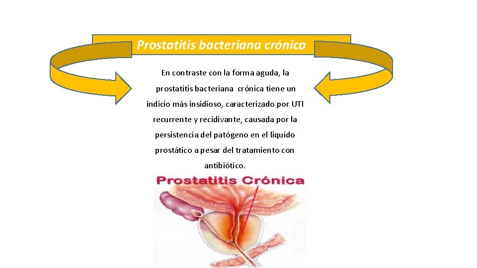 Prostatitis bacteriana crónica En contraste con la forma aguda, la prostatitis bacteriana crónica tiene