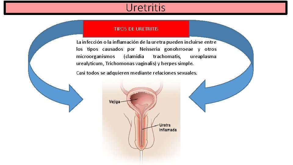 Uretritis TIPOS DE URETRITIS La infección o la inflamación de la uretra pueden incluirse