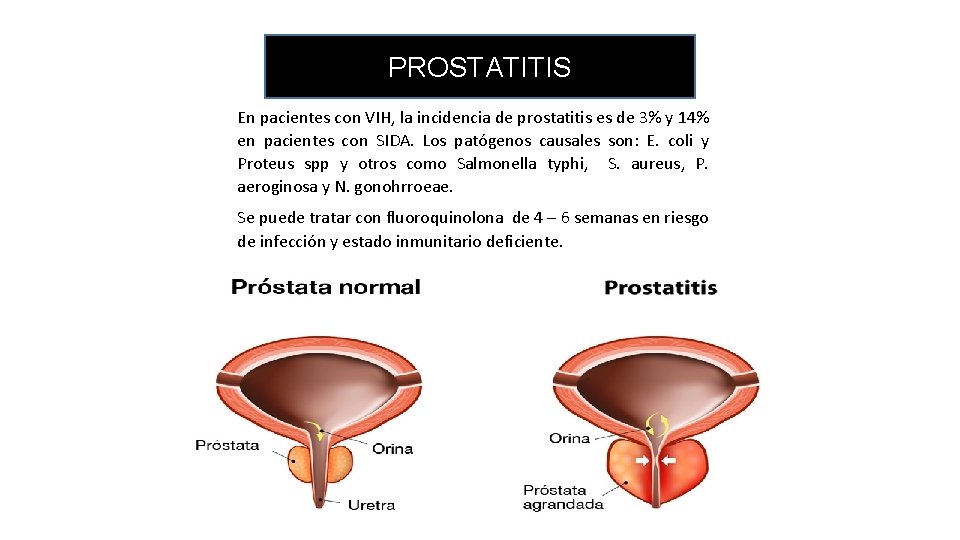 PROSTATITIS En pacientes con VIH, la incidencia de prostatitis es de 3% y 14%