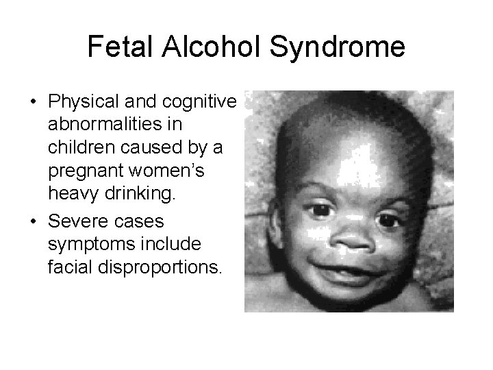 Fetal Alcohol Syndrome • Physical and cognitive abnormalities in children caused by a pregnant