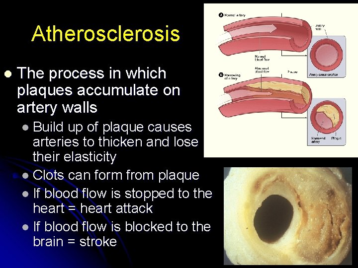Atherosclerosis l The process in which plaques accumulate on artery walls l Build up