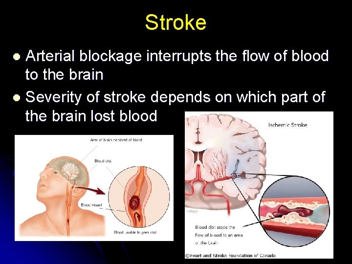 Stroke Arterial blockage interrupts the flow of blood to the brain l Severity of