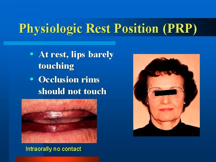 Physiologic Rest Position (PRP) At rest, lips barely touching Occlusion rims should not touch