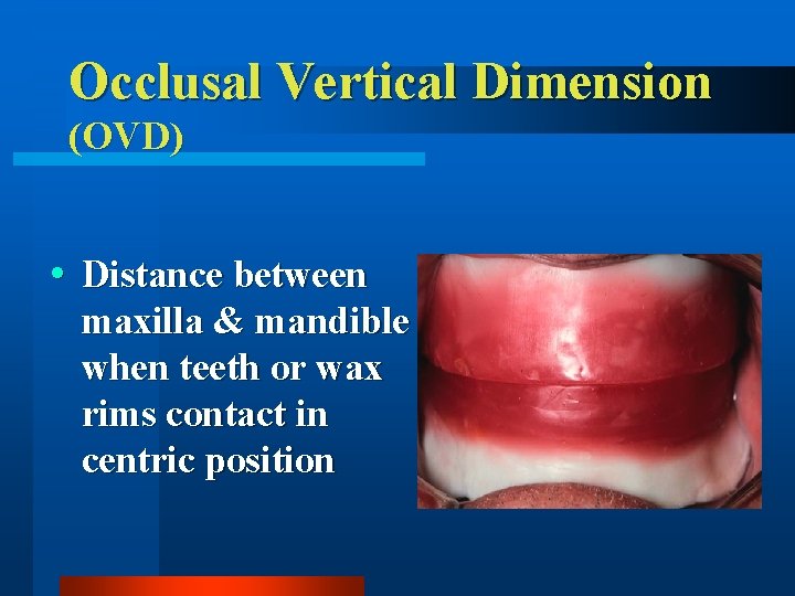 Occlusal Vertical Dimension (OVD) Distance between maxilla & mandible when teeth or wax rims