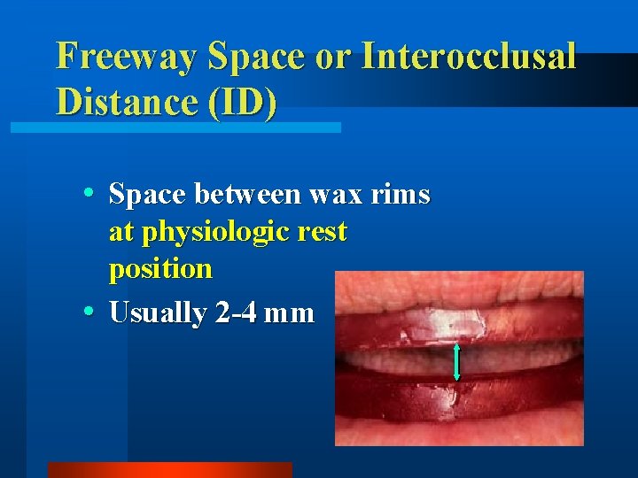 Freeway Space or Interocclusal Distance (ID) Space between wax rims at physiologic rest position