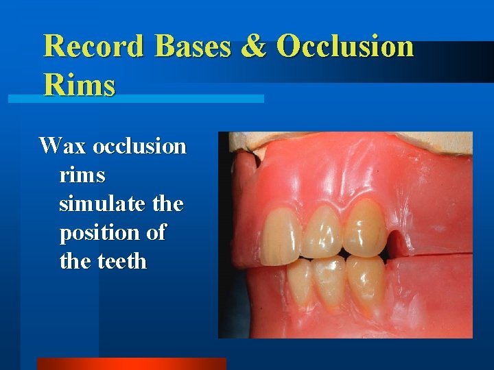 Record Bases & Occlusion Rims Wax occlusion rims simulate the position of the teeth