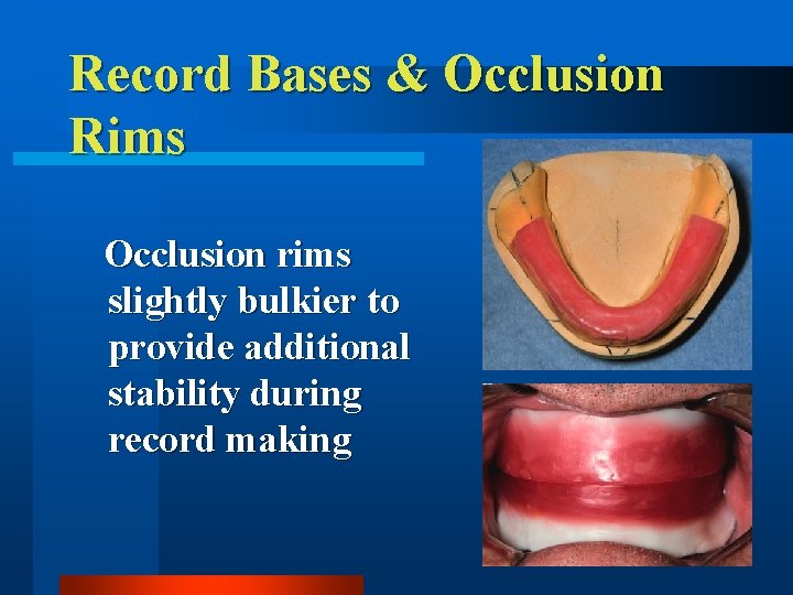 Record Bases & Occlusion Rims Occlusion rims slightly bulkier to provide additional stability during