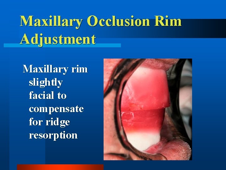 Maxillary Occlusion Rim Adjustment Maxillary rim slightly facial to compensate for ridge resorption 
