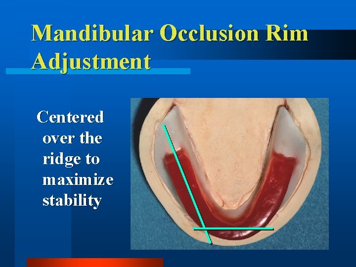 Mandibular Occlusion Rim Adjustment Centered over the ridge to maximize stability 