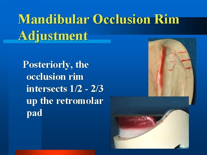 Mandibular Occlusion Rim Adjustment Posteriorly, the occlusion rim intersects 1/2 - 2/3 up the