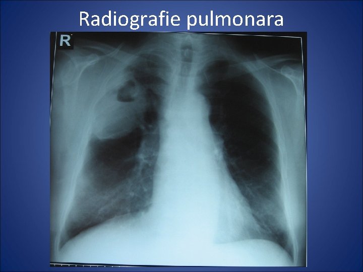 Radiografie pulmonara 