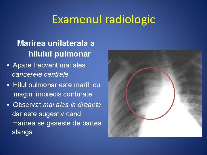 Examenul radiologic Marirea unilaterala a hilului pulmonar • Apare frecvent mai ales cancerele centrale