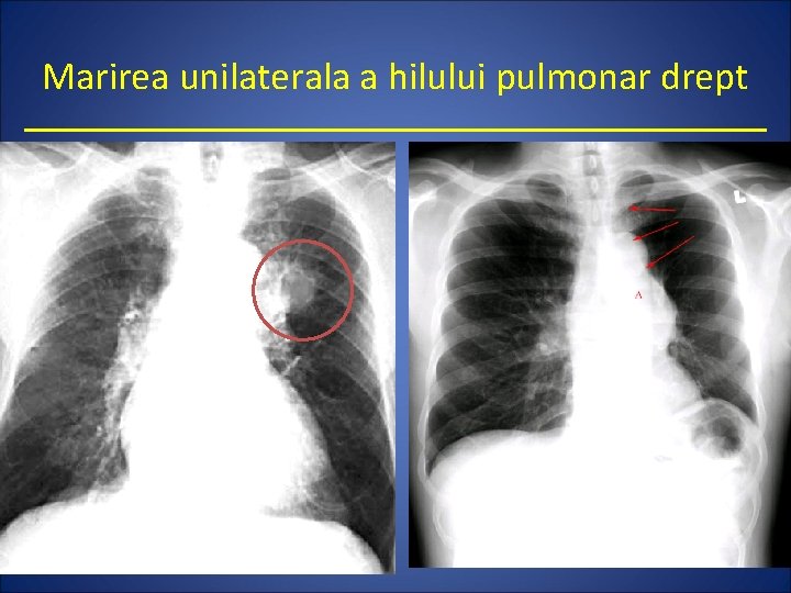 Marirea unilaterala a hilului pulmonar drept 