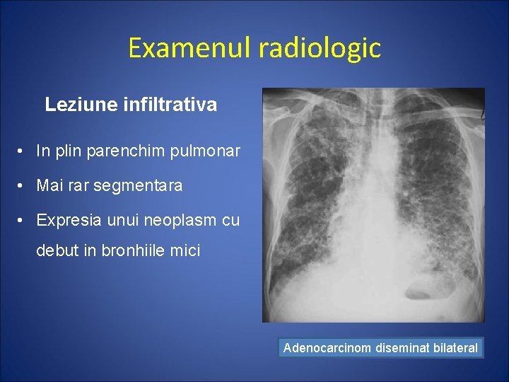 Examenul radiologic Leziune infiltrativa • In plin parenchim pulmonar • Mai rar segmentara •