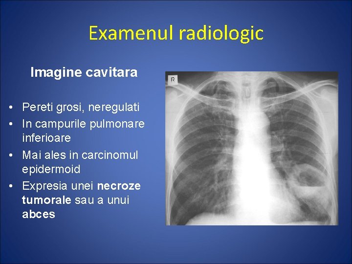 Examenul radiologic Imagine cavitara • Pereti grosi, neregulati • In campurile pulmonare inferioare •