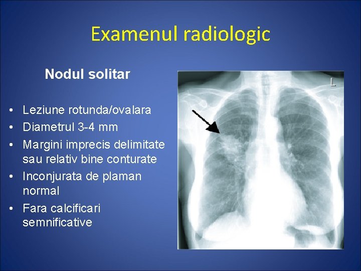 Examenul radiologic Nodul solitar • Leziune rotunda/ovalara • Diametrul 3 -4 mm • Margini