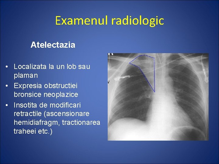 Examenul radiologic Atelectazia • Localizata la un lob sau plaman • Expresia obstructiei bronsice