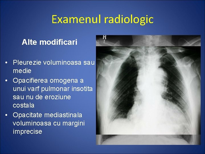 Examenul radiologic Alte modificari • Pleurezie voluminoasa sau medie • Opacifierea omogena a unui