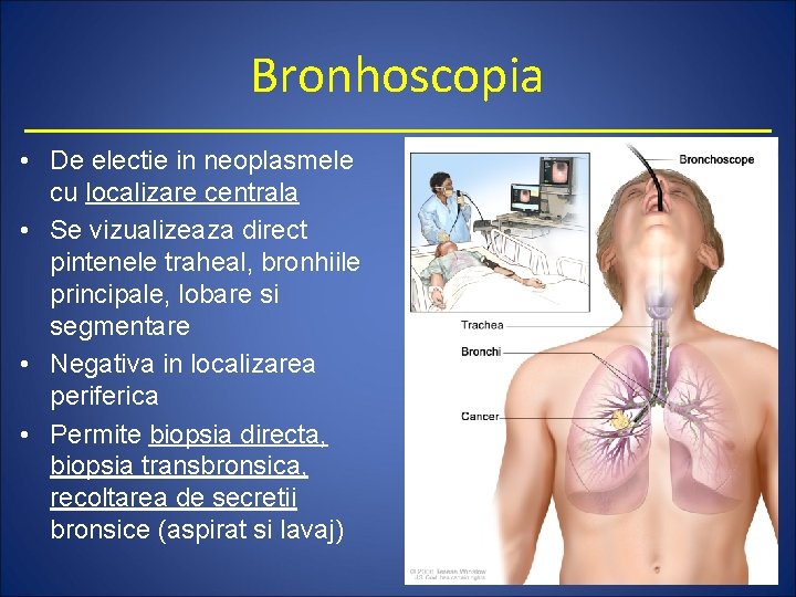 Bronhoscopia • De electie in neoplasmele cu localizare centrala • Se vizualizeaza direct pintenele