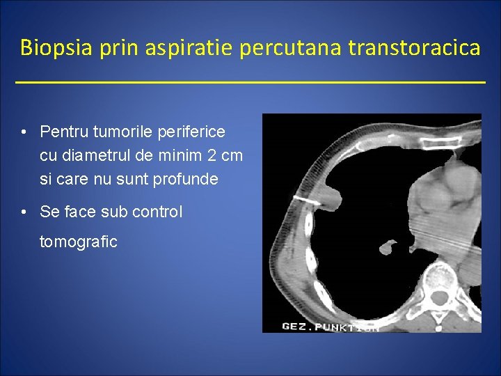 Biopsia prin aspiratie percutana transtoracica • Pentru tumorile periferice cu diametrul de minim 2