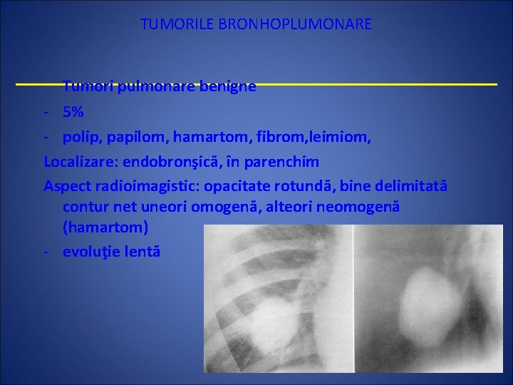 TUMORILE BRONHOPLUMONARE Tumori pulmonare benigne - 5% - polip, papilom, hamartom, fibrom, leimiom, Localizare: