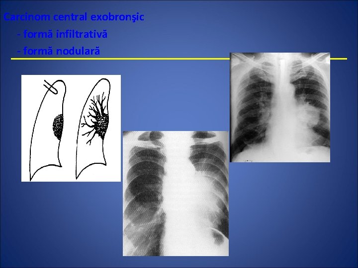 Carcinom central exobronşic - formă infiltrativă - formă nodulară 