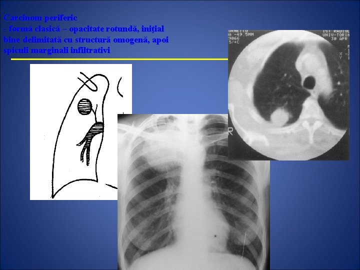 Carcinom periferic - formă clasică – opacitate rotundă, iniţial bine delimitată cu structură omogenă,