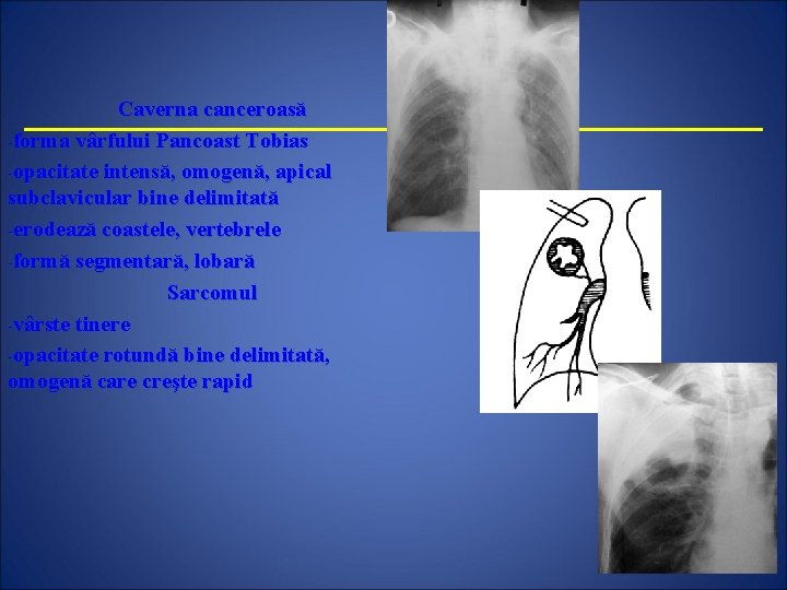 Caverna canceroasă -forma vârfului Pancoast Tobias -opacitate intensă, omogenă, apical subclavicular bine delimitată -erodează