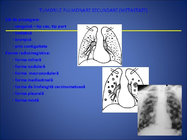 TUMORILE PULMONARE SECUNDARE (METASTAZE) Căi de propagare: - sangvină – tip cav, tip port