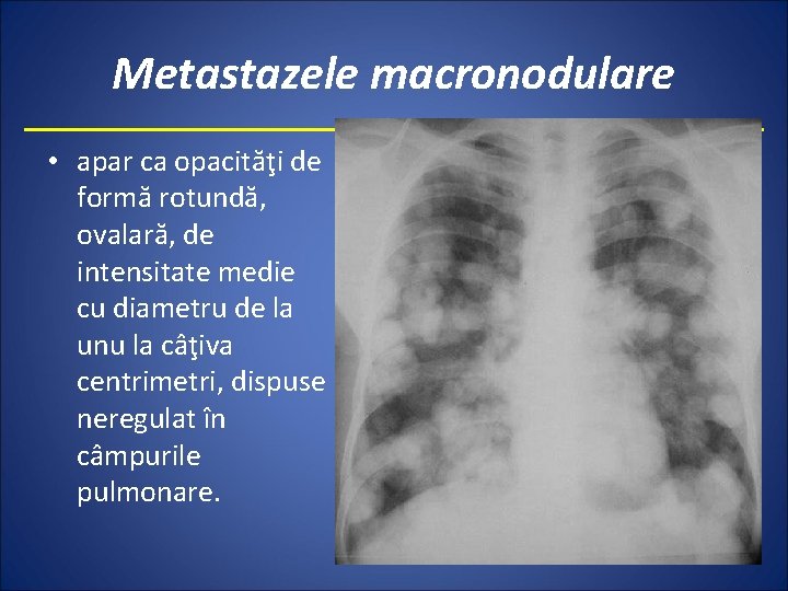 Metastazele macronodulare • apar ca opacităţi de formă rotundă, ovalară, de intensitate medie cu