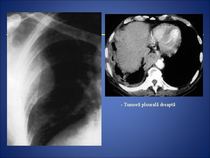 - Tumoră pleurală dreaptă 