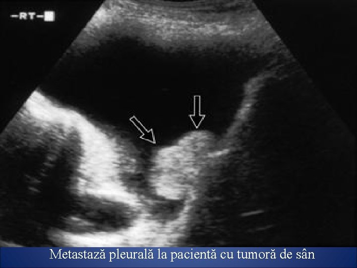 Metastază pleurală la pacientă cu tumoră de sân 