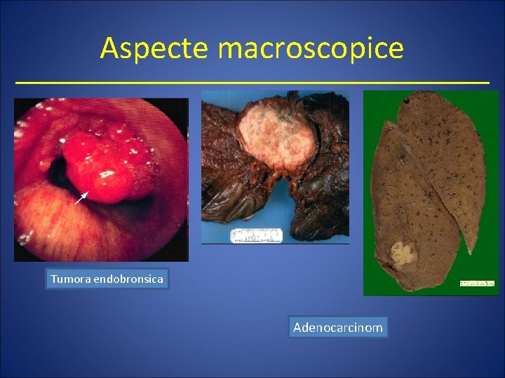 Aspecte macroscopice Tumora endobronsica Adenocarcinom 