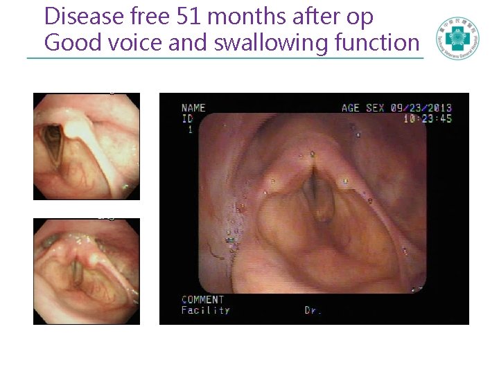 Disease free 51 months after op Good voice and swallowing function 