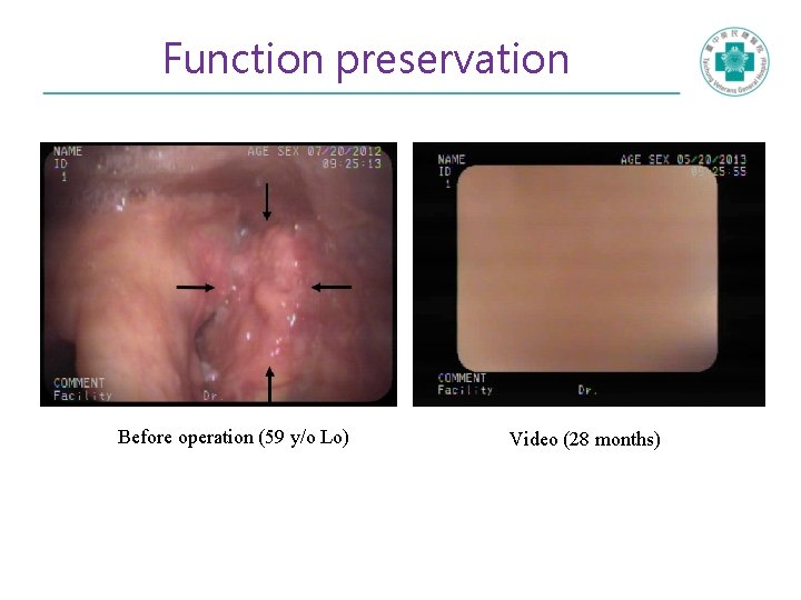 Function preservation Before operation (59 y/o Lo) Video (28 months) 
