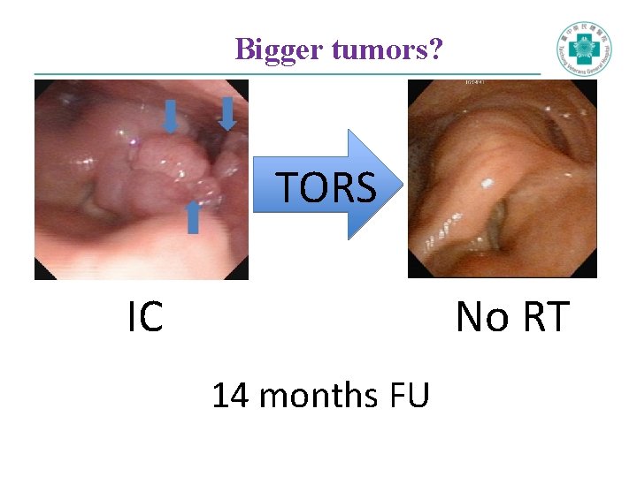 Bigger tumors? TORS IC No RT 14 months FU 