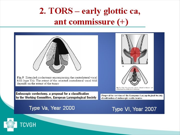 2. TORS – early glottic ca, ant commissure (+) 