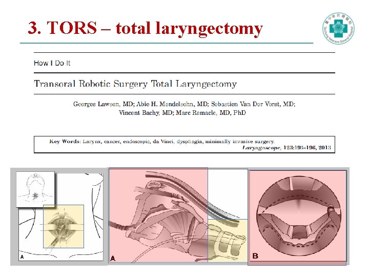 3. TORS – total laryngectomy 