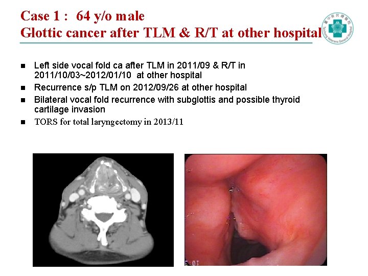 Case 1 : 64 y/o male Glottic cancer after TLM & R/T at other