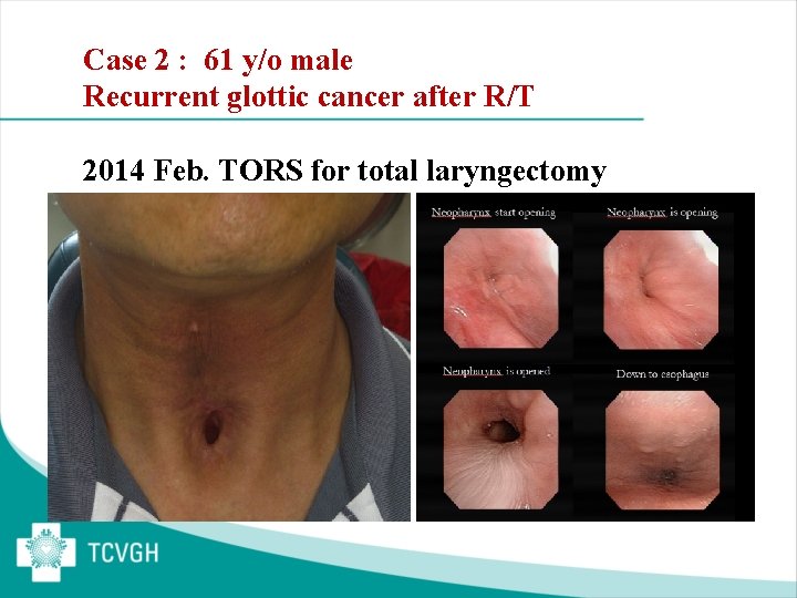 Case 2 : 61 y/o male Recurrent glottic cancer after R/T 2014 Feb. TORS