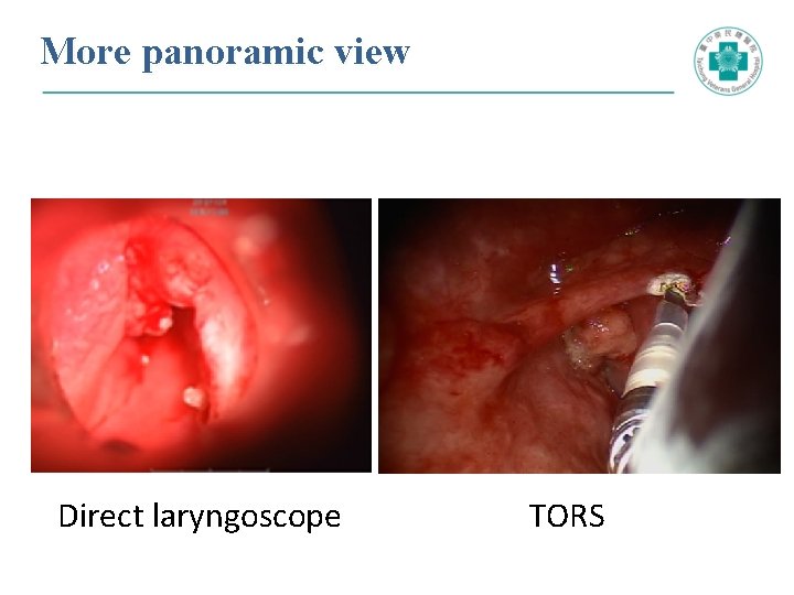 More panoramic view Direct laryngoscope TORS 