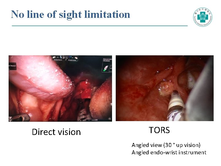 No line of sight limitation Direct vision TORS Angled view (30 ° up vision)