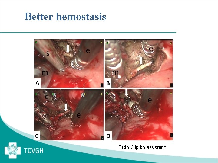 Better hemostasis Endo Clip by assistant 