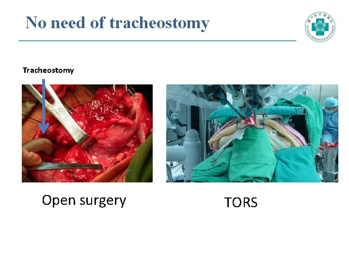 No need of tracheostomy Tracheostomy Open surgery TORS 