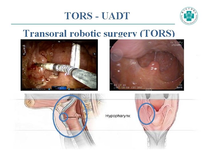 TORS - UADT Transoral robotic surgery (TORS) 