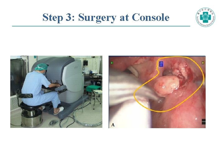 Step 3: Surgery at Console 